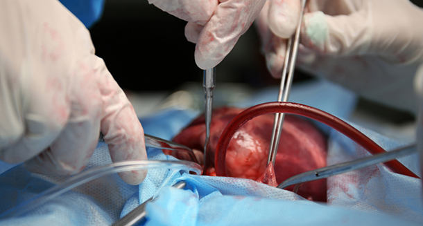 doctors performing heart operation closeup